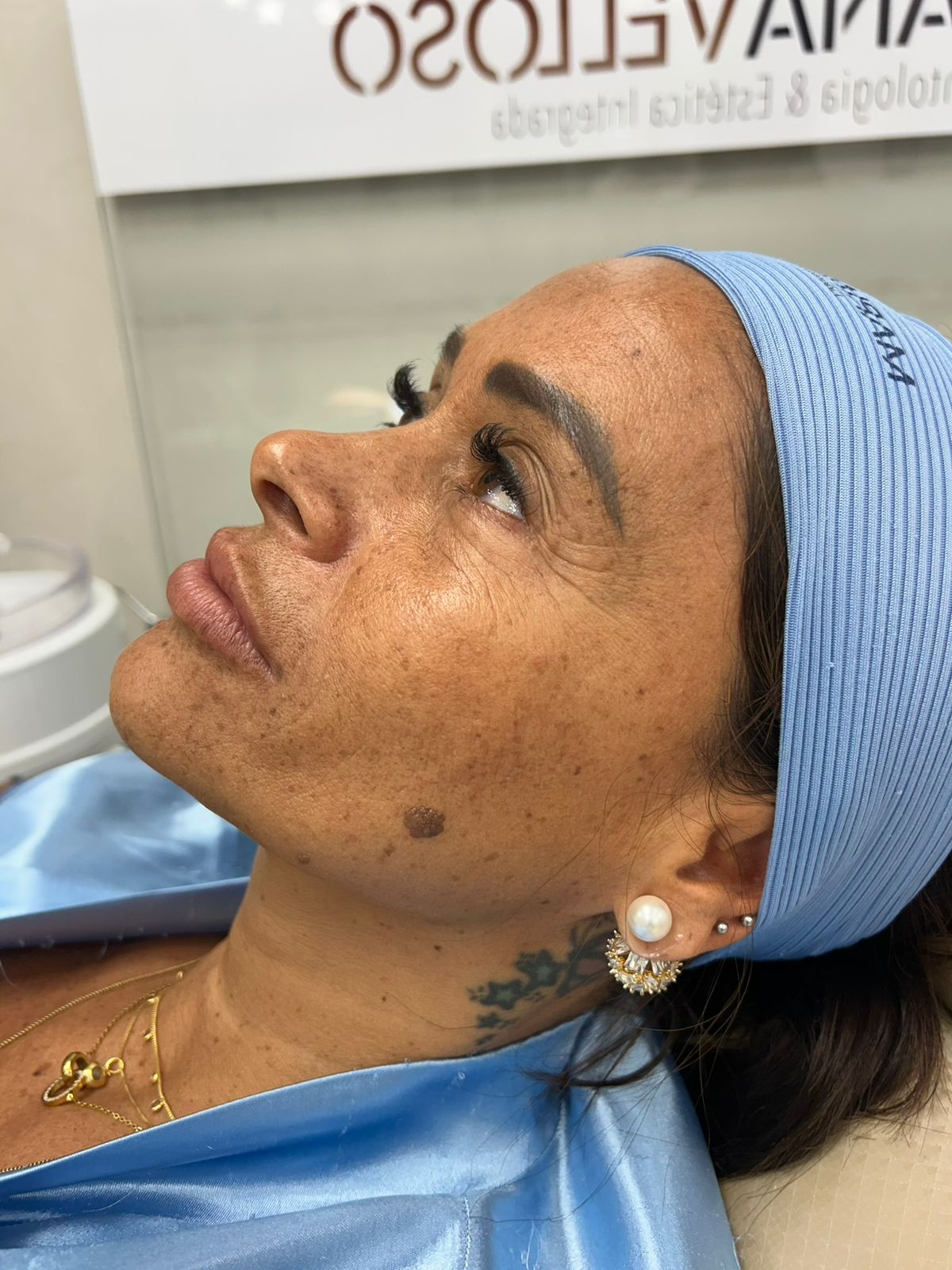 Antes — perfil facial feminino antes da harmonização